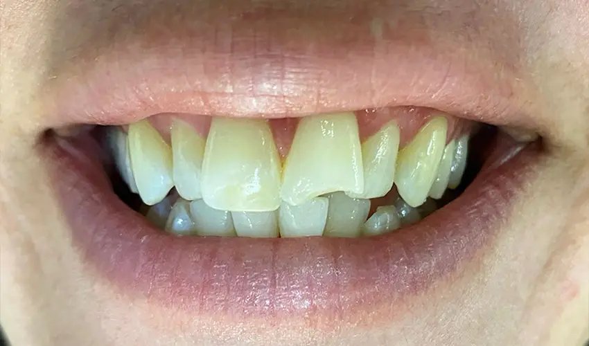 Before dental veneers transformation Las Vegas patient 2
